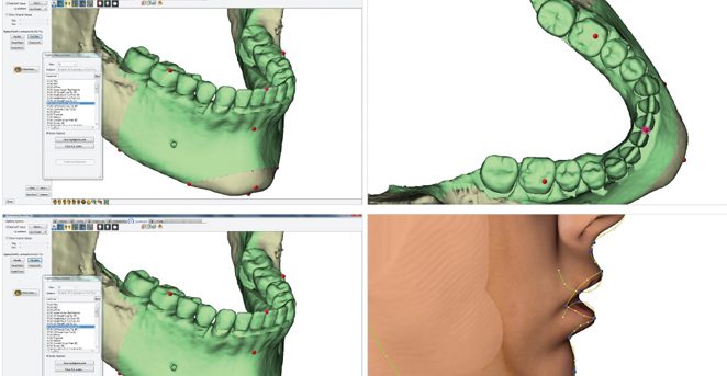 Ortodoncia quirúrgica. Ortodoncia en Avilés. Clínica Dental Villalaín