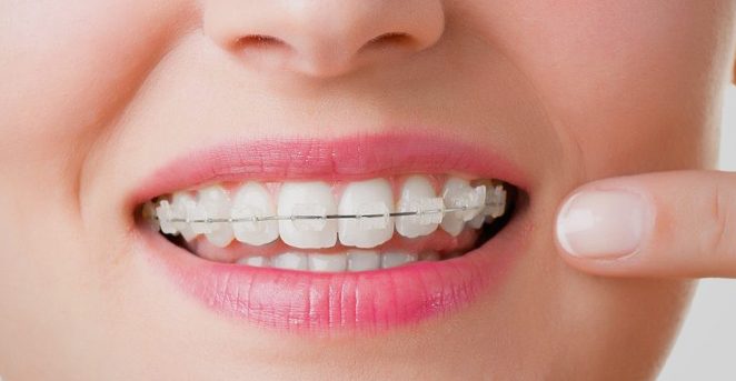 Ortodoncia con brackets. Ortodoncia en Avilés