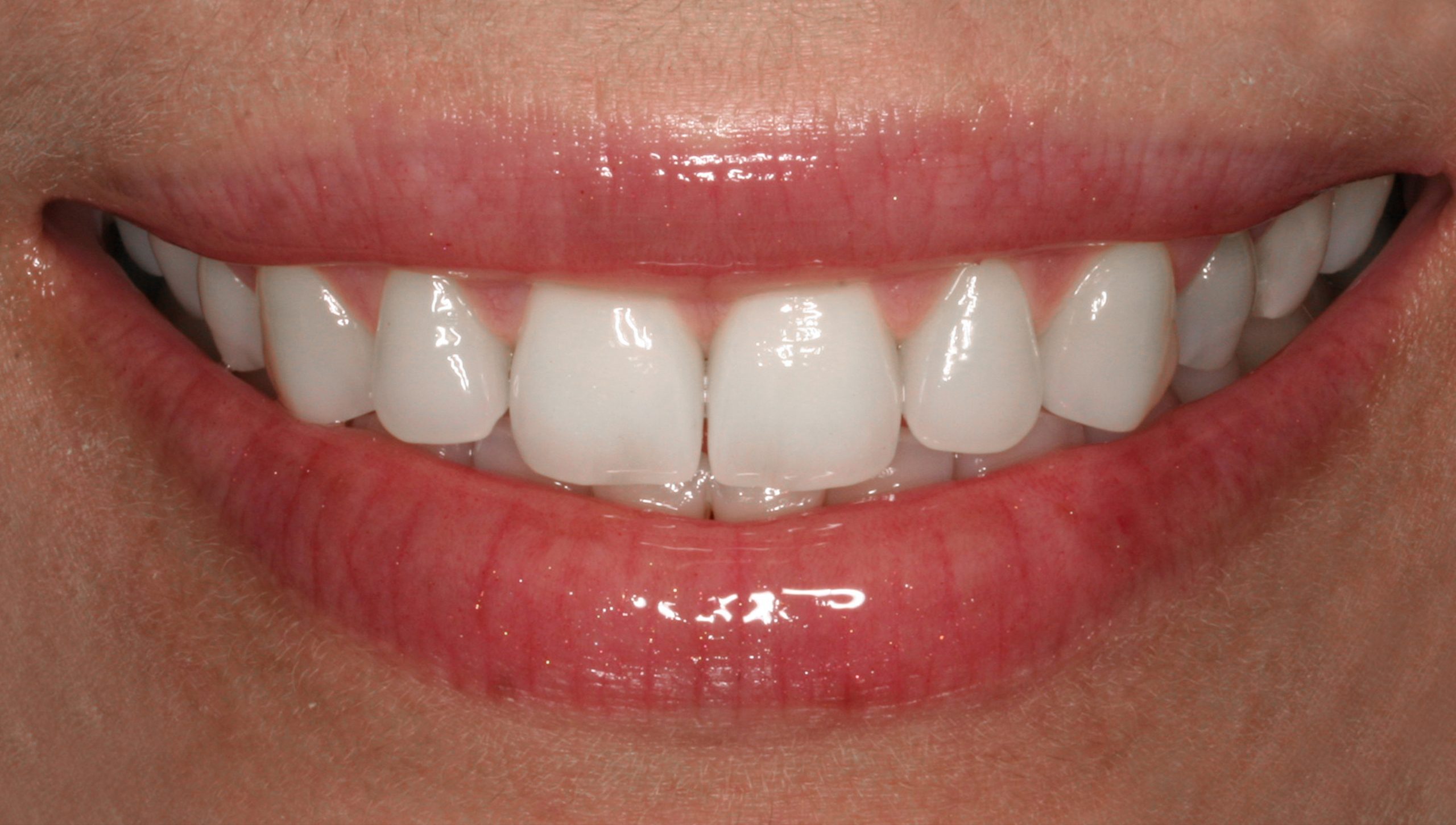 antes