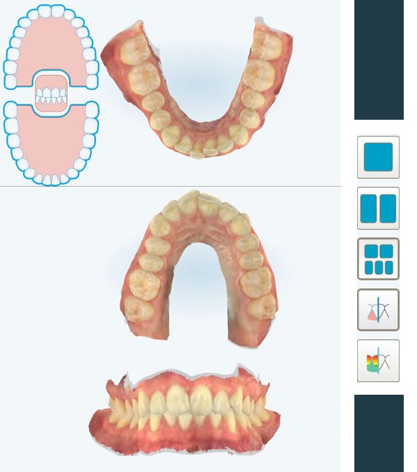 ESCANER INTRAORAL 2