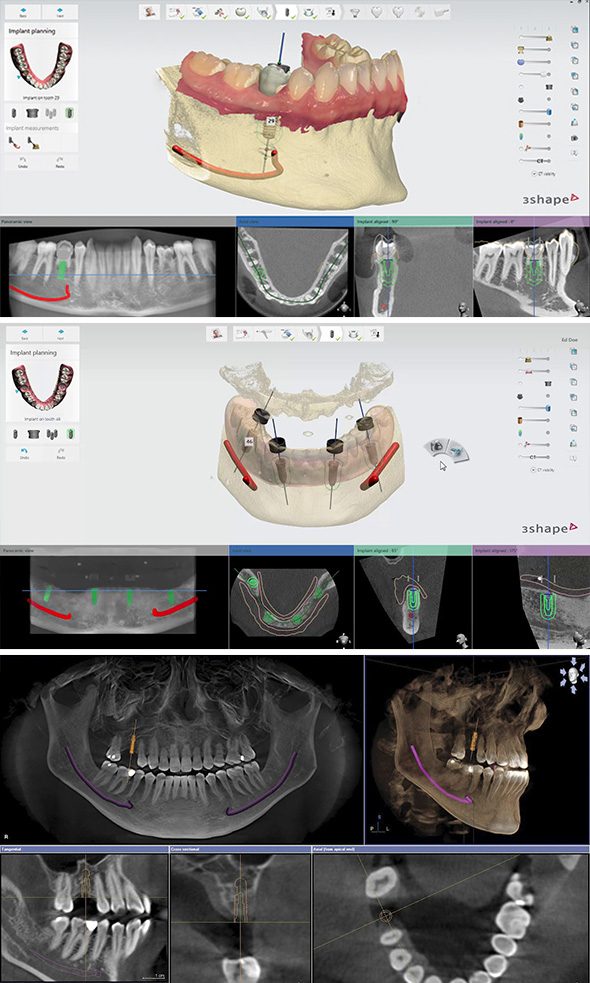 IMPLANTOLOGIA DIGITAL