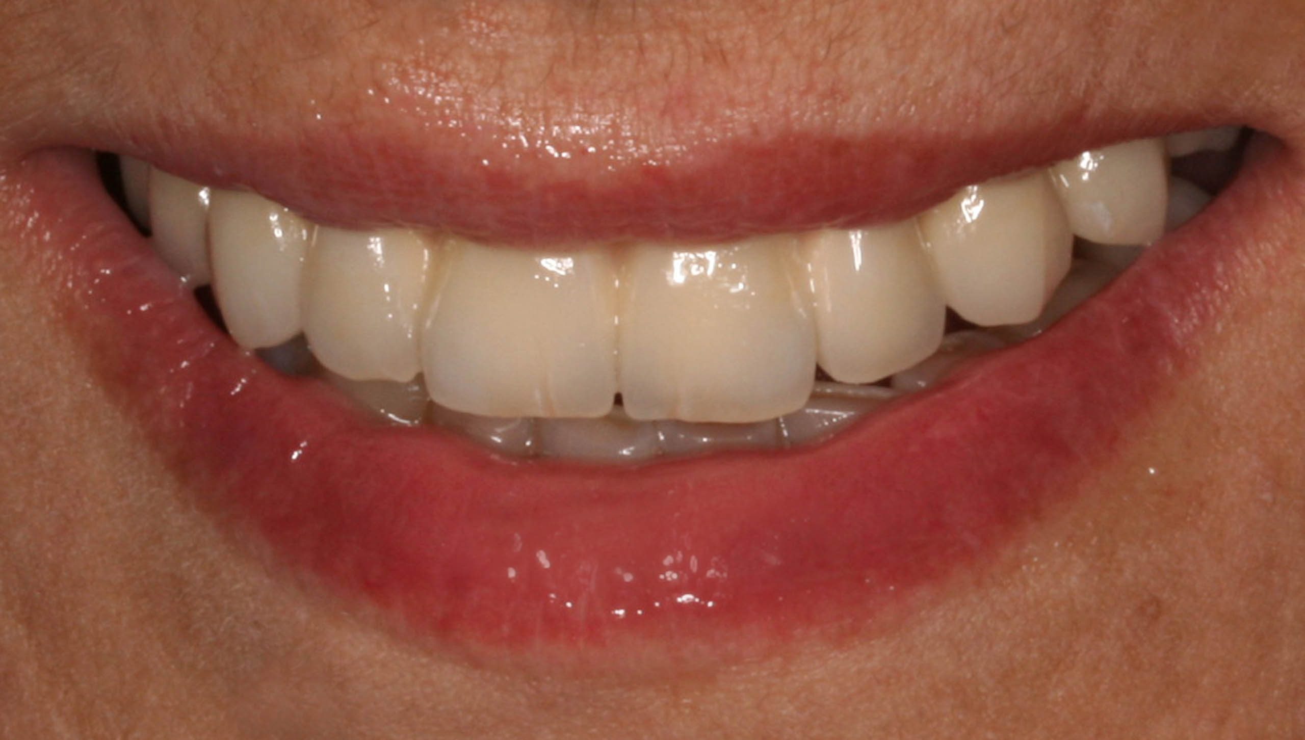 antes