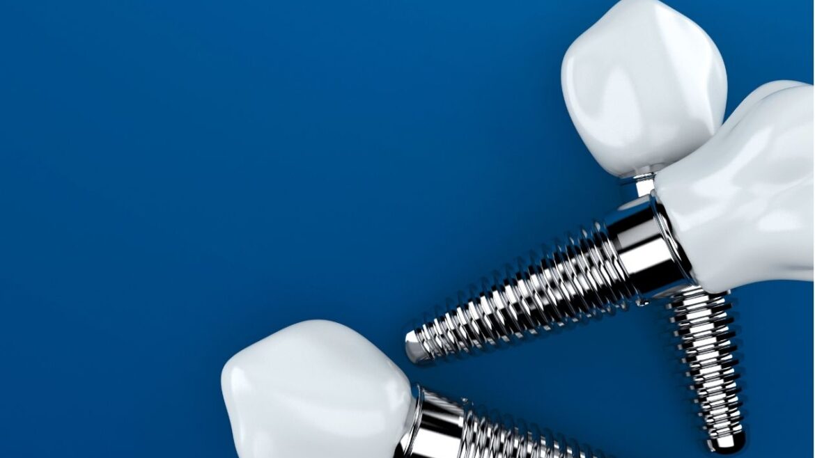 mitos sobre implantes dentales en aviles asturias clinica dental villalain