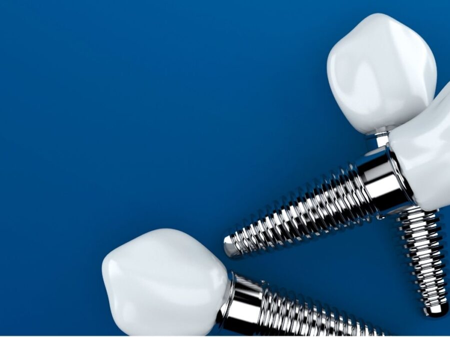 mitos sobre implantes dentales en aviles asturias clinica dental villalain