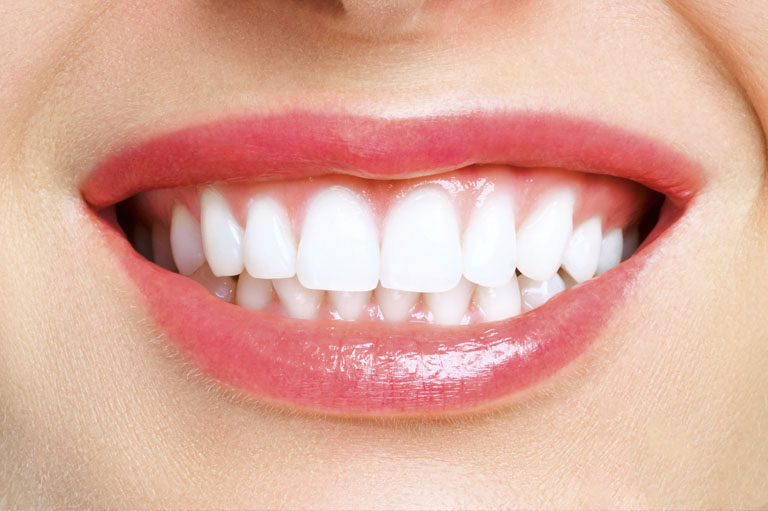 Blanqueamiento dental en Avilés