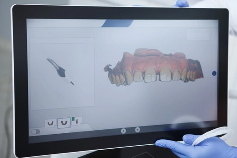 Clínica Villalain. Escáner Intraoral con un modelo de dentadura en pantalla.