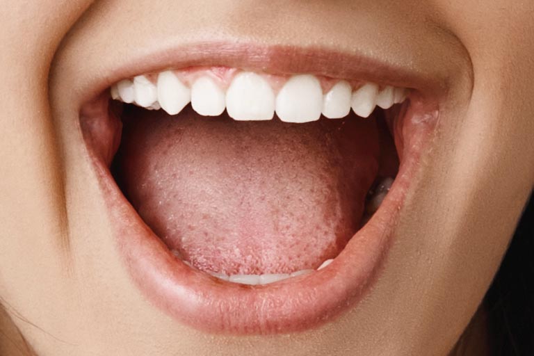 Clínica Dental Villalaín. Qué es la candidiasis oral