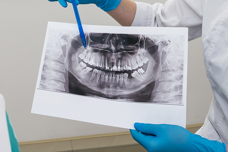 Clínica-Villalaín.-Tipos-de-Radiografía-en-la-Clínica-Dental-en-Avilés