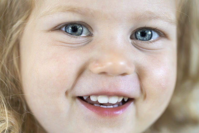 caries en bebés