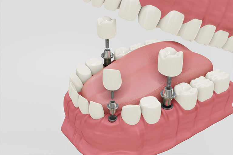 implantes de carga inmediata