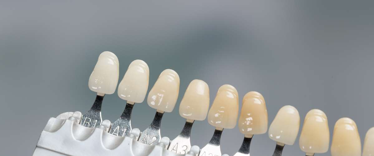 Selección meticulosa del tono de blanco ideal para carillas dentales, garantizando una sonrisa natural y armoniosa.