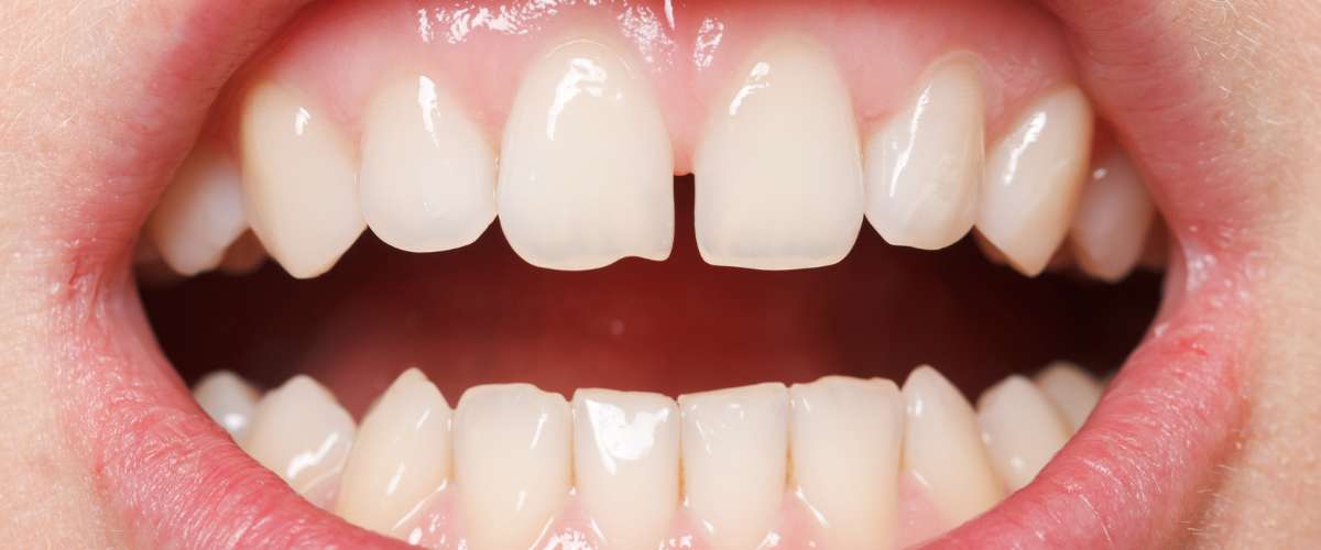 Diastema: espacio visible entre dos dientes, comúnmente conocido como 'dientes separados'.