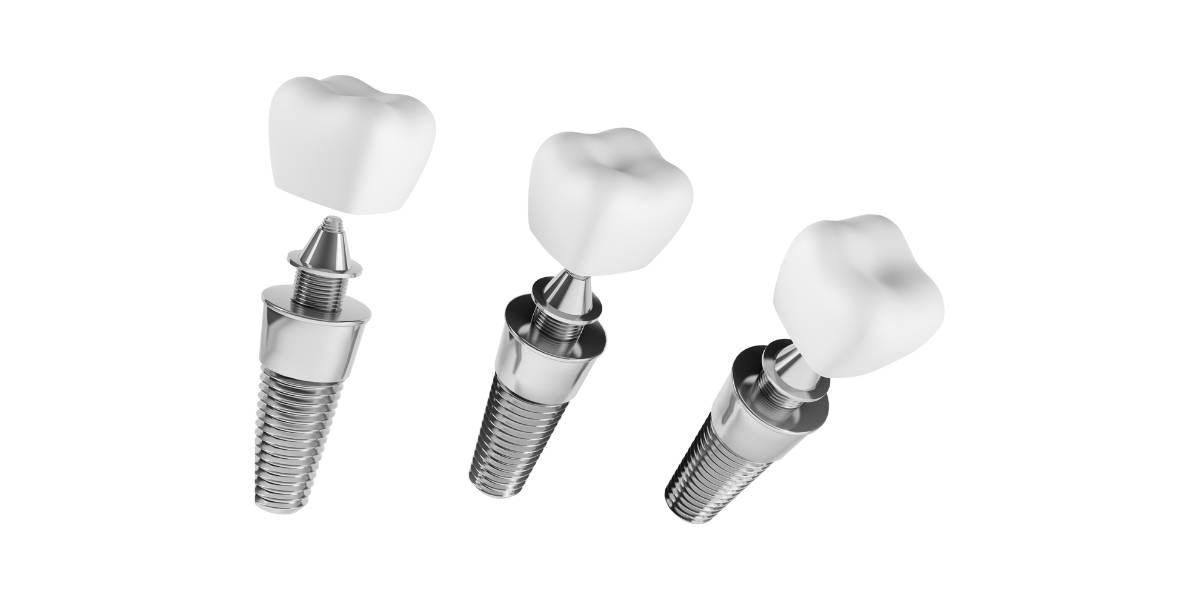 Anatomía de un implante dental: desde la raíz artificial hasta la corona visible.