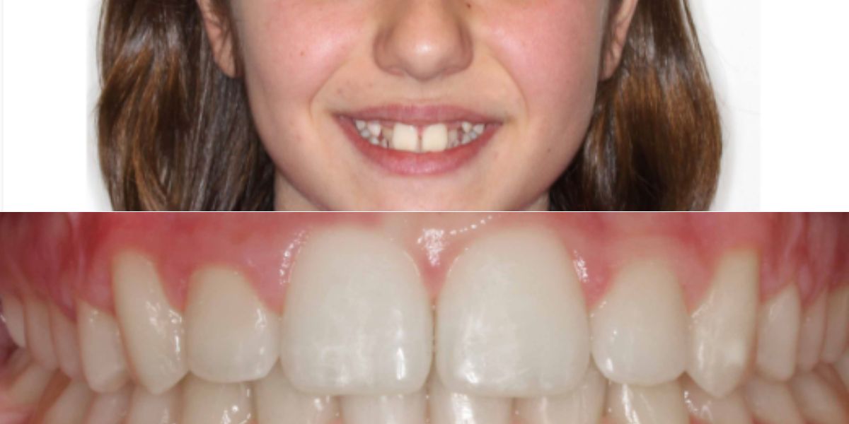 Caso real de ortodoncia en Clínica Villalaín