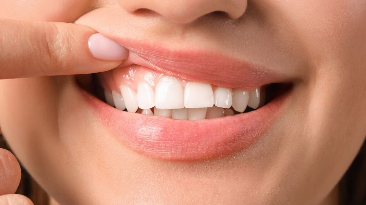 Blanqueamiento dental casero - Clinica Villalain - Dentista Aviles