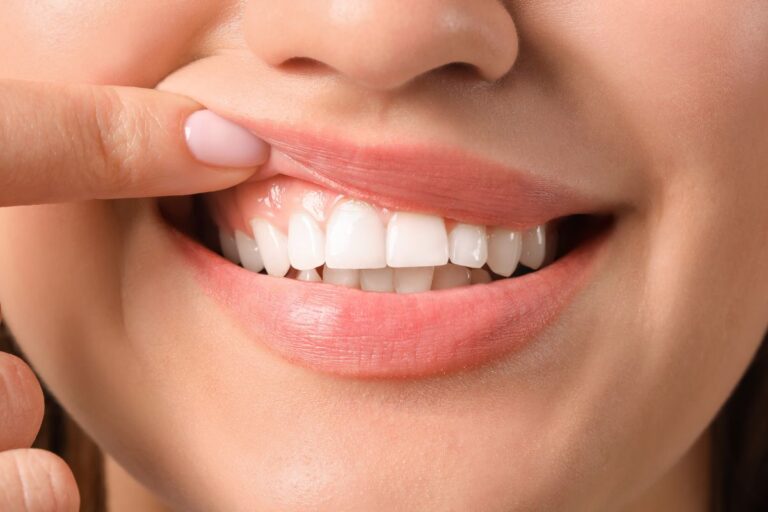 Blanqueamiento dental casero - Clinica Villalain - Dentista Aviles