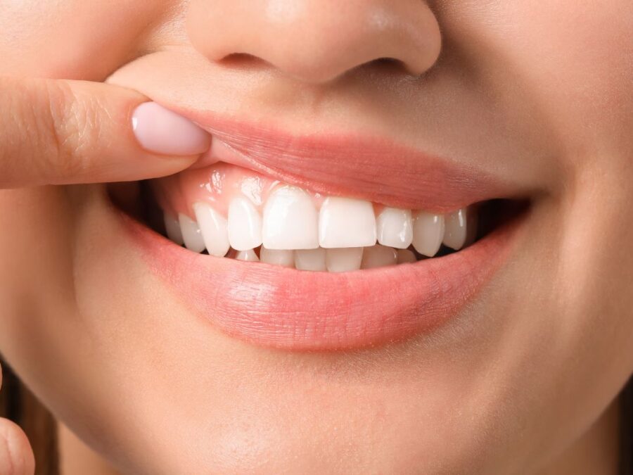 Blanqueamiento dental casero - Clinica Villalain - Dentista Aviles