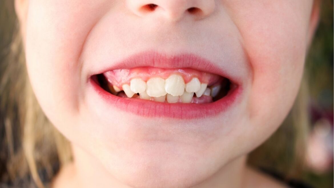 ¿La caries se transmite?. Tus dentistas en Avilés te informan