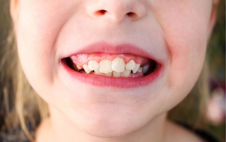 ¿La caries se transmite?. Tus dentistas en Avilés te informan