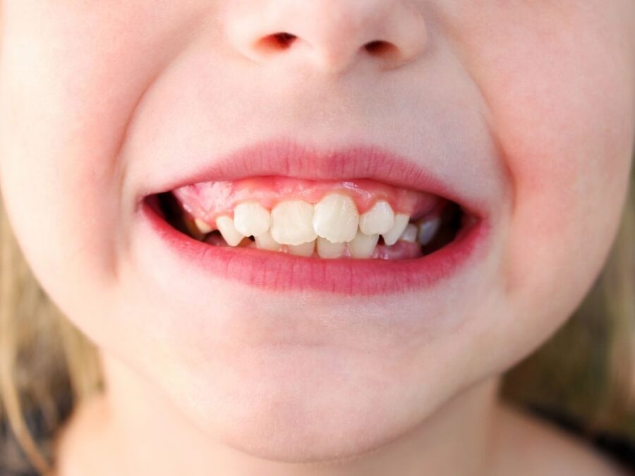 ¿La caries se transmite?. Tus dentistas en Avilés te informan