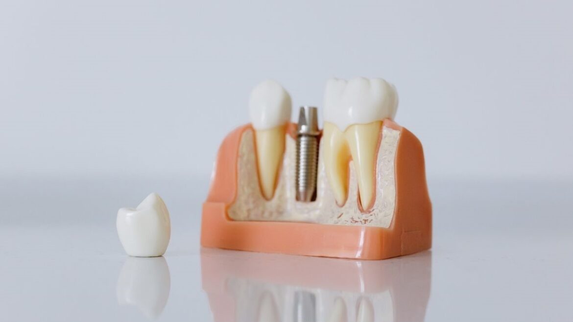 Tipos implantes dentales