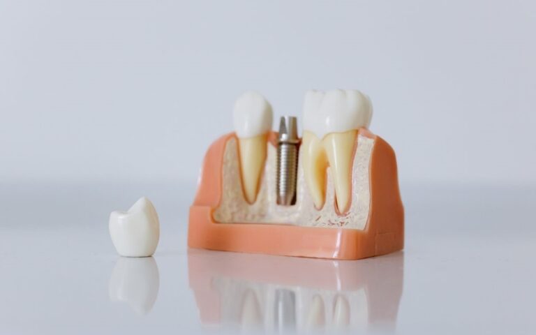 Tipos implantes dentales
