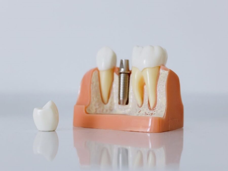 Tipos implantes dentales