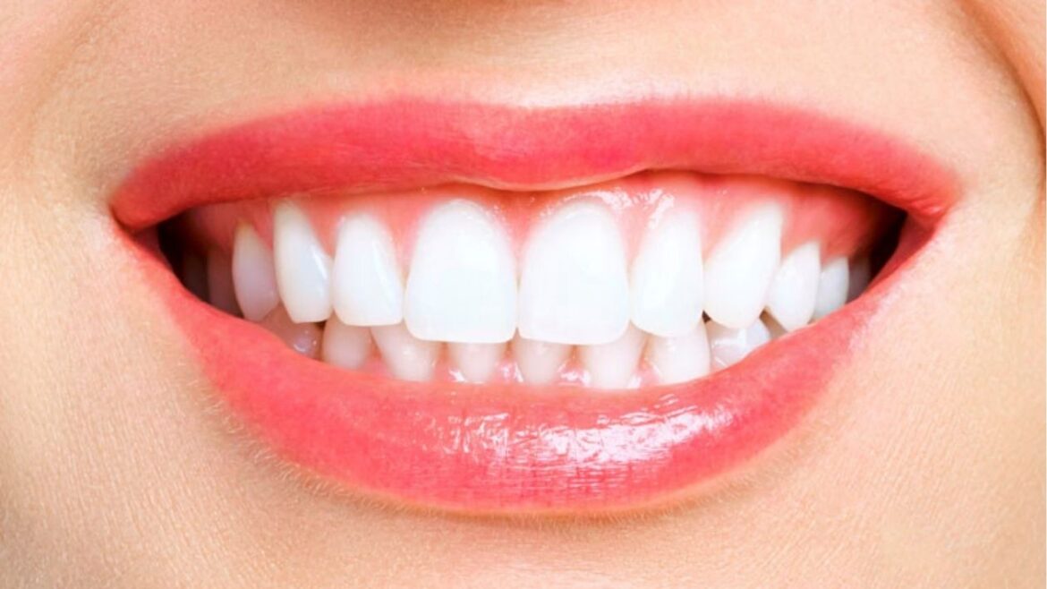 blanqueamiento dental