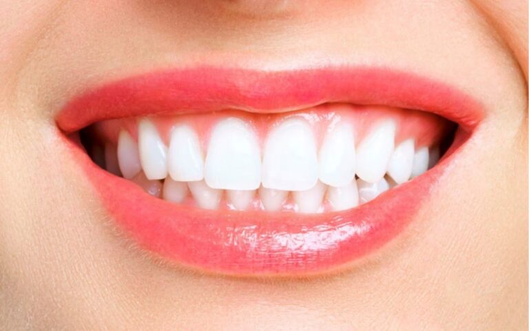 blanqueamiento dental