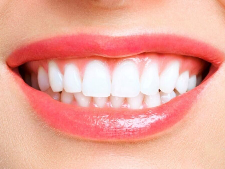 blanqueamiento dental