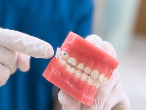 Maloclusión dental, ¿cómo corregirla con ortodoncia?