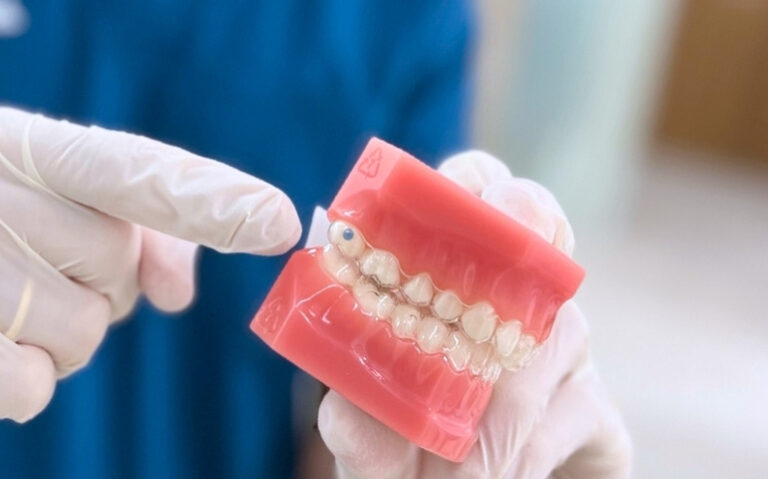 Maloclusión dental, ¿cómo corregirla con ortodoncia?