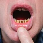 Dientes negros, cómo solucionarlo. Clínica Villalaín, tu dentista en Avilés