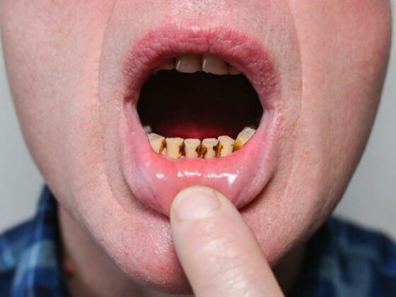 Dientes negros, cómo solucionarlo. Clínica Villalaín, tu dentista en Avilés