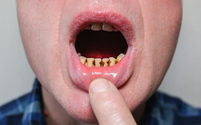 Dientes negros, cómo solucionarlo. Clínica Villalaín, tu dentista en Avilés