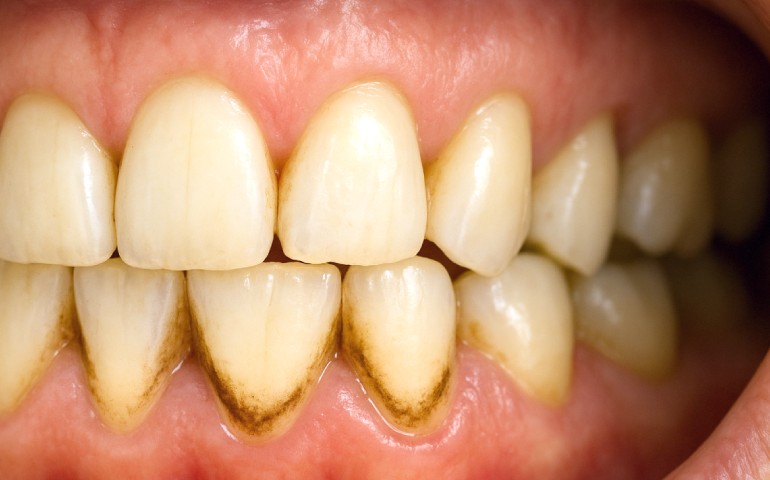 Paciente con sarro y dientes negros
